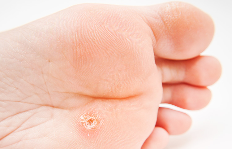 Wart